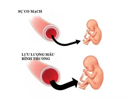 Nguyên nhân của hội chứng tiền sản giật là do lượng canxi cung cấp cho thai phụ không đầy đủ.